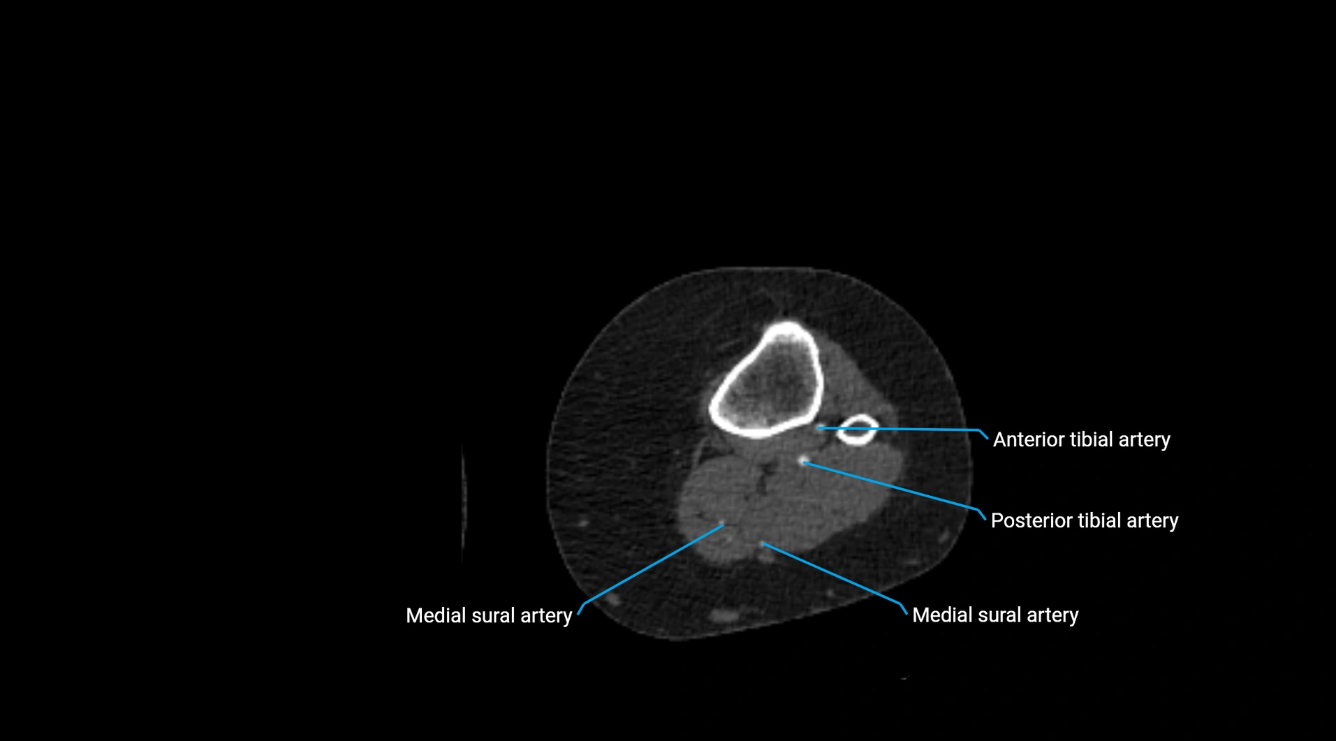 CTA lower limb cross sectional anatomy labelled image _186.webp
